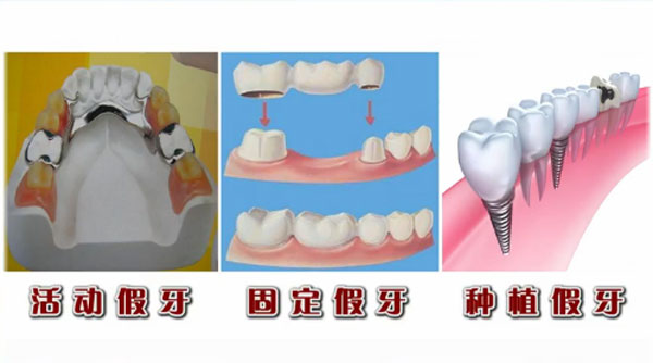 什么是口腔义齿制造？口腔义齿制造是从事什么工作？插图1